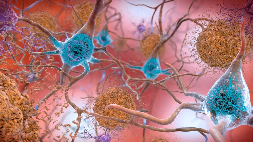 An illustration of proteins clumped around neurons in the brain. 
